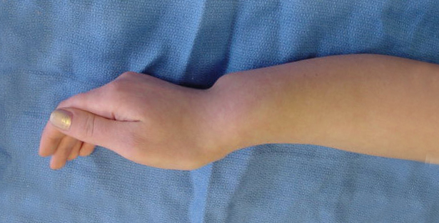 Madelung’s deformity of right wrist in 14 year old female lateral view