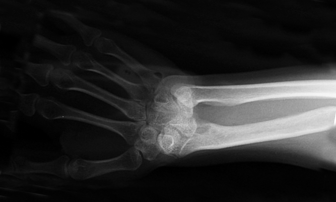 Madelung’s AP X-ray right wrist