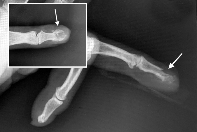 Distal phalanx shaft anf tuft fracture (arrow) associated with nail plate loss and nail bed laceration