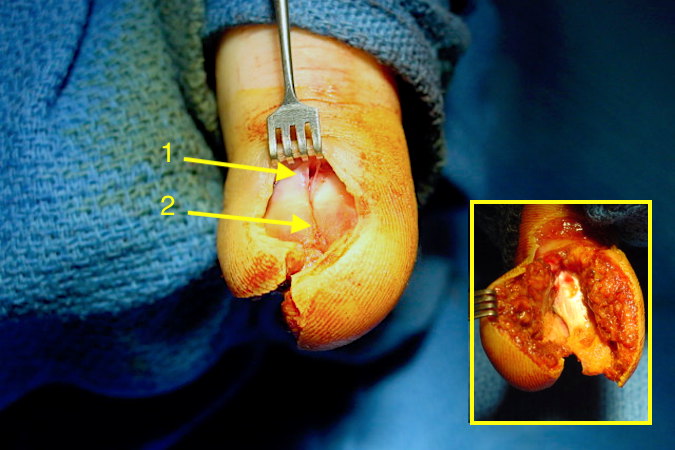 Complex nail bed laceration through germinal matrix (1) and sterile matrix (2) with pulp laceration  and exposed distal phalanx