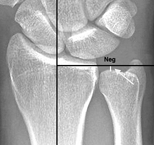 In this X-ray the negative ulnar variance (arrow) in millimeters (mm) is being measured with the method of perpendiculars (ref 14). The forearm is in neutral rotation, wrist at neutral deviation and flexion/extension, and the elbow at 90 degrees of flexion.  The PA X-ray has been taken with the  beam at a zero degree angle of incidence. (ref 15)