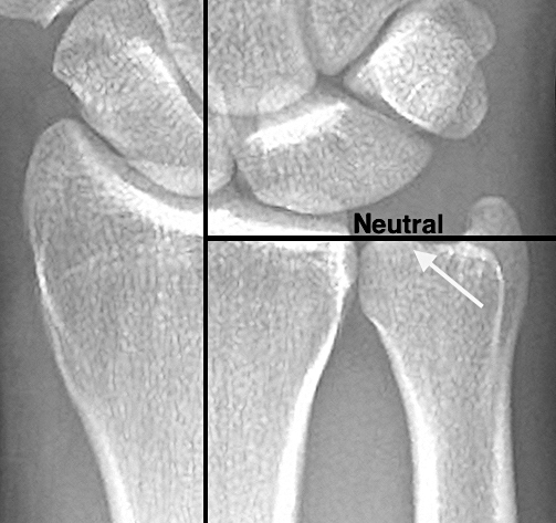 When the distal radius and distal ulna are equal in length at the distal radioulnar joint, the ulnar variance is neutral. In this X-ray the ulnar variance is being measured with the method of perpendiculars (ref 14). The forearm is in neutral rotation, wrist at neutral deviation and flexion/extension, and the elbow at 90 degrees of flexion.  The X-ray beam is at a zero degree angle of incidence for this PA view. (ref 15).