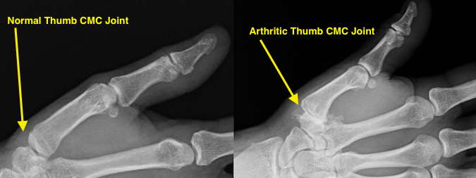 Normal and arthritic thumb
