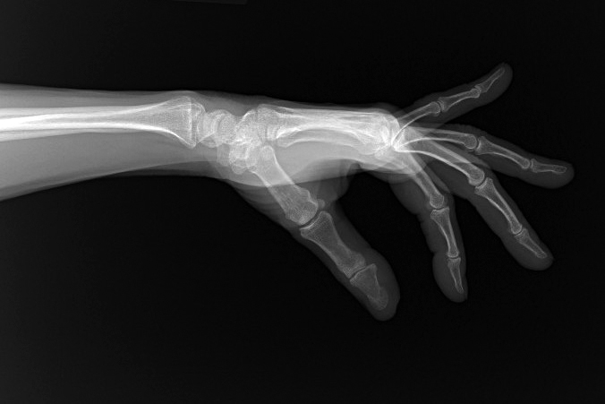 Pisotriquetral joint very difficult to visualize on routine lateral X-ray of the wrist.