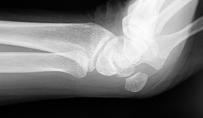 Pisotriquetral Osteoarthritis with minimal joint space narrowing. No cysts, no osteophytes and intact cartilage space as seen on this "ball catcher's" view of the wrist.