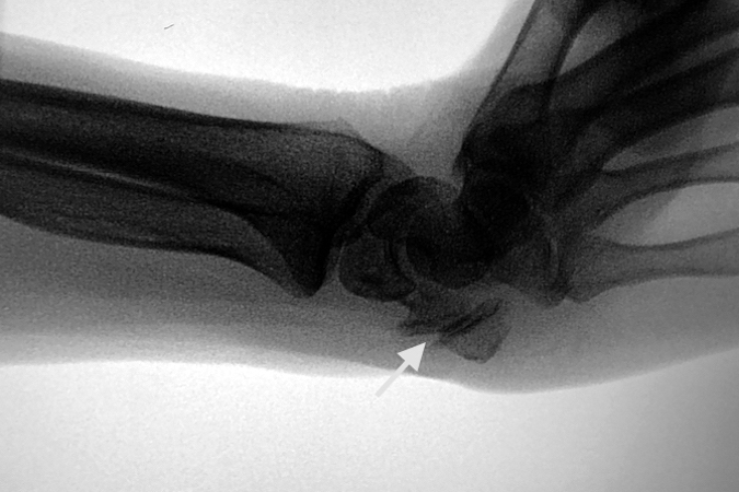 Pisotriquetral Osteoarthritis (arrow) - Note marked joint narrowing and osteophytes in this "ball catcher's view of the wrist.