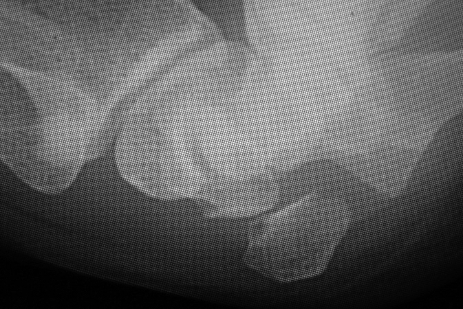 Pisotriquetral Osteoarthritis (arrow) - Note marked joint narrowing and pisiform cysts in this "ball catcher's view of the wrist.