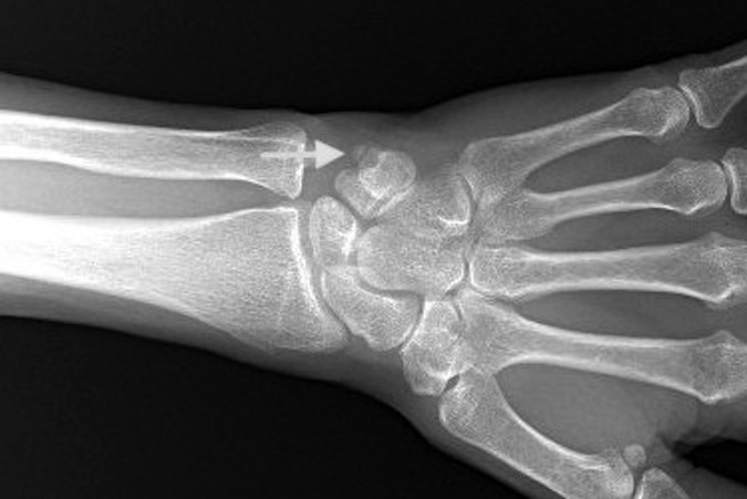 Pisotriquetral Osteoarthritis AP X-ray with pointing to osteophyte. OA of P-T joint difficult to visualize on AP view.