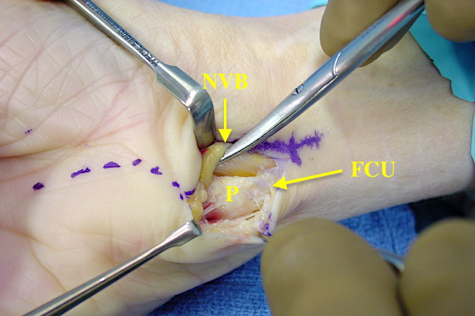Excision of the pisiform for pisotriquetral osteoarthritis through the proximal part of an extended carpal tunnel incision.  Pisiform (P); Neurovascular bundle (NVB); Flexor car ulnas (FCU)