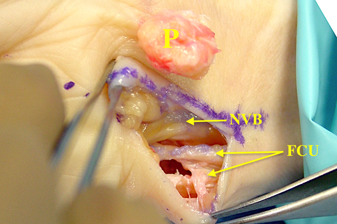 Excision of the pisiform. Pisiform completely removed (P). The neurovasciular bundle (NVB) i.e. ulnar artery and nerve intact. Flexor Carpi Ulnaris (FCU) split to be sutured before closure. 