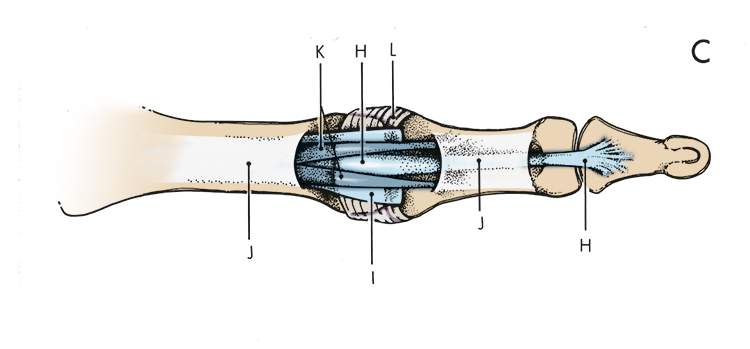 H. Flexor digitorum profundus; I. Volar plate; J. A-2 & A-4 pulley; K. Flexor digitorum superficialis; L. Transverse retinaculum. During a flexor tendon avulsion injury the FDP (H) is torn from its insertion into the distal phalanx.
