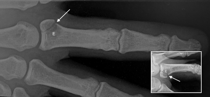 Left handed carpenter was nailing a small board while pushing the board in place with his right long finger when he felt a pop followed by pain and swelling at the base of the long finger.  X-ray shows a RCL pathologic avulsion fracture (arrow) secondary to an enchrondroma. (E). Insert shows oblique view.