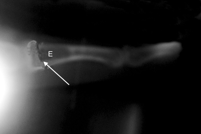 Nondisplaced pathologic fracture (lateral view) of the left long finger middle phalanx (arrow) secondary to an enchondroma (E).