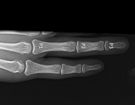 X-ray of ring and little fingers in PA view. P1=Proximal Phalanx; P2=Middle Phalanx; P3=Distal Phalanx