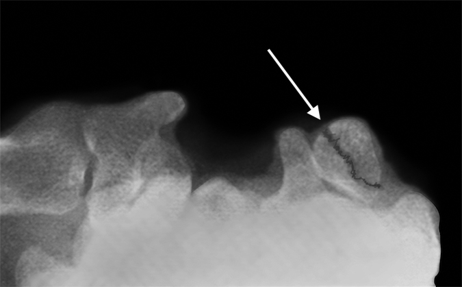 Non-displaced pisiform fracture (arrow).