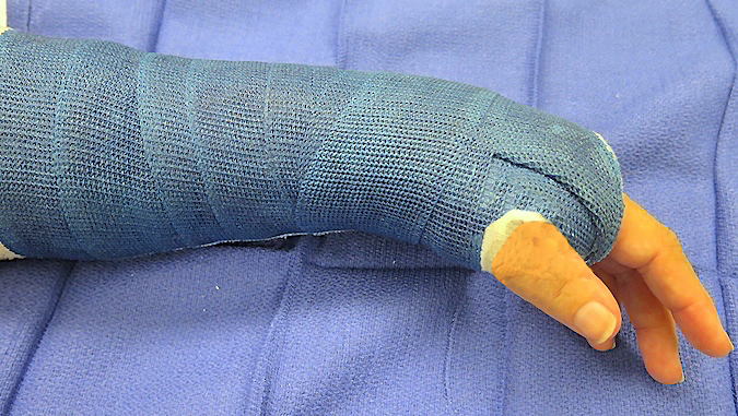 Short arm cast treatment for an acute non-displaced pisiform fracture.