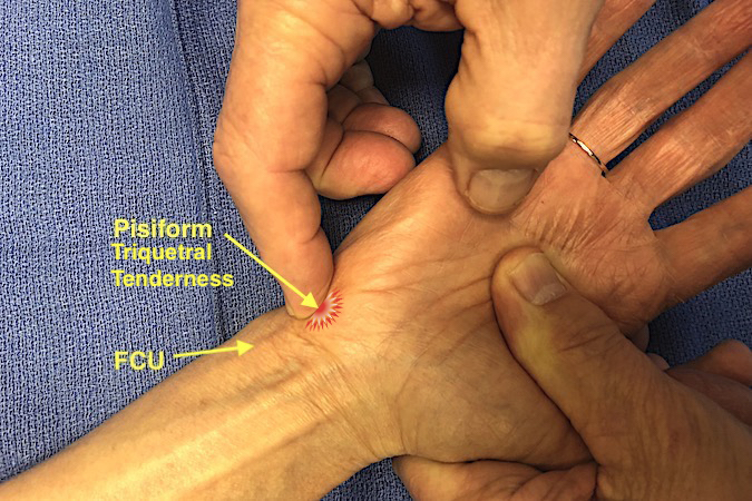 Examine the pisiform triquetral joint for tenderness.  FCU (flexor carpi ulnaris)