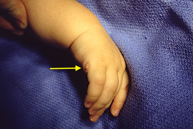 Skin deformity after a right fifth finger polydactyly with small skin and neurovascular bundle was removed by tying off the pedicle in the newborn nursery.