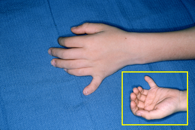 Polydactyly left hand with extra fifth finger dorsal and palmar views