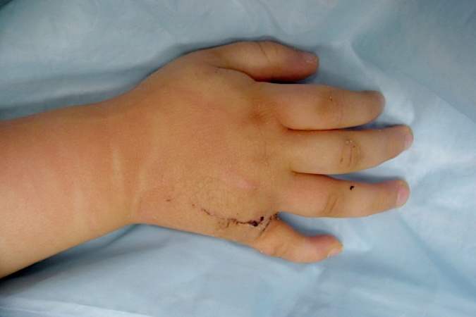 Right fifth finger polydactyly most correction at suture removal. Mild swelling still present.