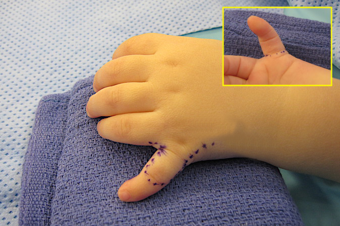 Left fifth finger polydactyly with incision plan