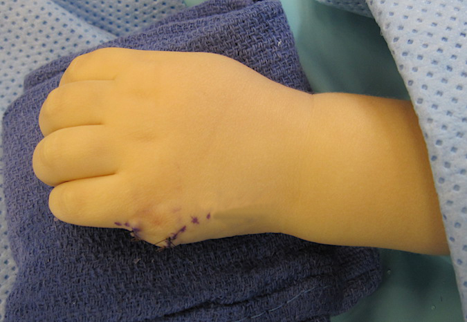 Left fifth finger polydactyly closure after excise of extra partial ray and reconstruction.