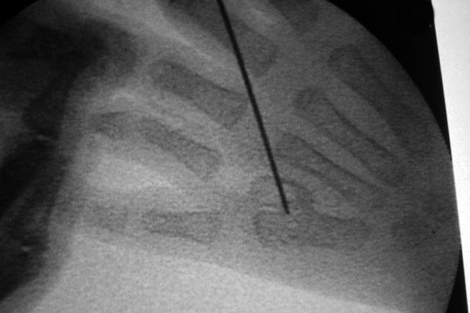 Operative mini-fluoroscopy with K-wire performed to localize and document junction point of bifid metacarpal.