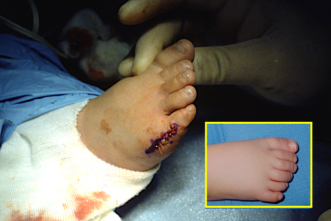 Right foot after excision of extra fifth toe