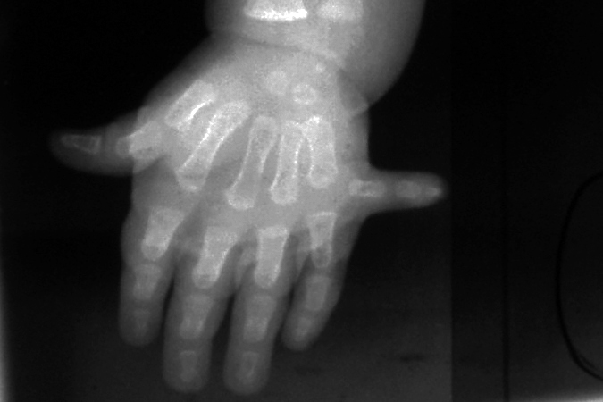 Polydactyly X-ray left hand with extra fifth finger