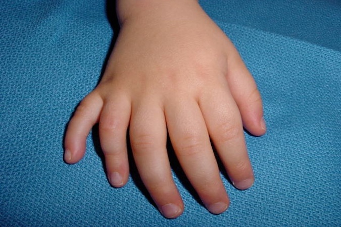 Polydactyly right hand with extra fifth finger