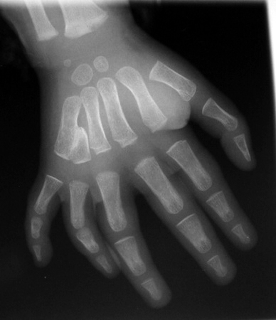 Polydactyly X-ray right hand with extra fifth finger