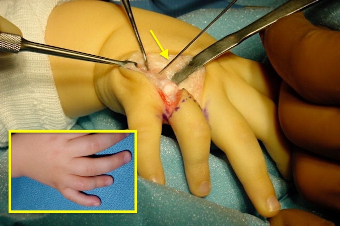 Right fifth finger polydactyly (insert). Fifth partial ray being being excised because of its incomplete metacarpal.  Pin (arrow) in the metacarpal junction point.