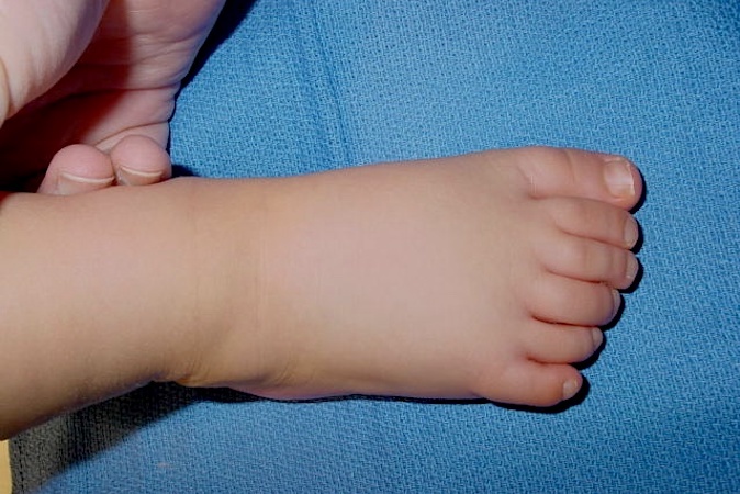 Polydactyly of  the hand can be associated with polydactyly of the toes.