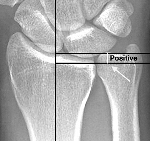 In this X-ray the positive ulnar variance (arrow) in millimeters (mm) is being measured with the method of perpendiculars (ref 14). The forearm is in neutral rotation, wrist at neutral deviation and flexion/extension, and the elbow at 90 degrees of flexion.  The PA X-ray has been taken with the  beam at a zero degree angle of incidence. (ref 15)