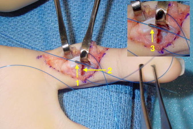  Volar plate rupture right fifth finger being repaired.  Note 1-retracted flexor tendons; 2-Edge of volar plate; 3-Keith needle for passing sutures through drill hole in base of the middle phalanx.