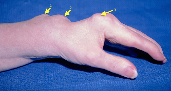 Rheumatoid hand and wrist (1) subluxed distal ulna, (2) dorsal tenosynovitis, (3) MP joint synovitis