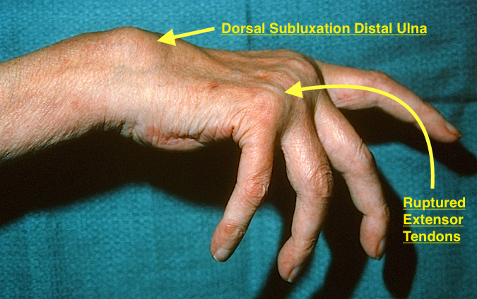 Dorsally subluxated distal ulna (Piano Key)