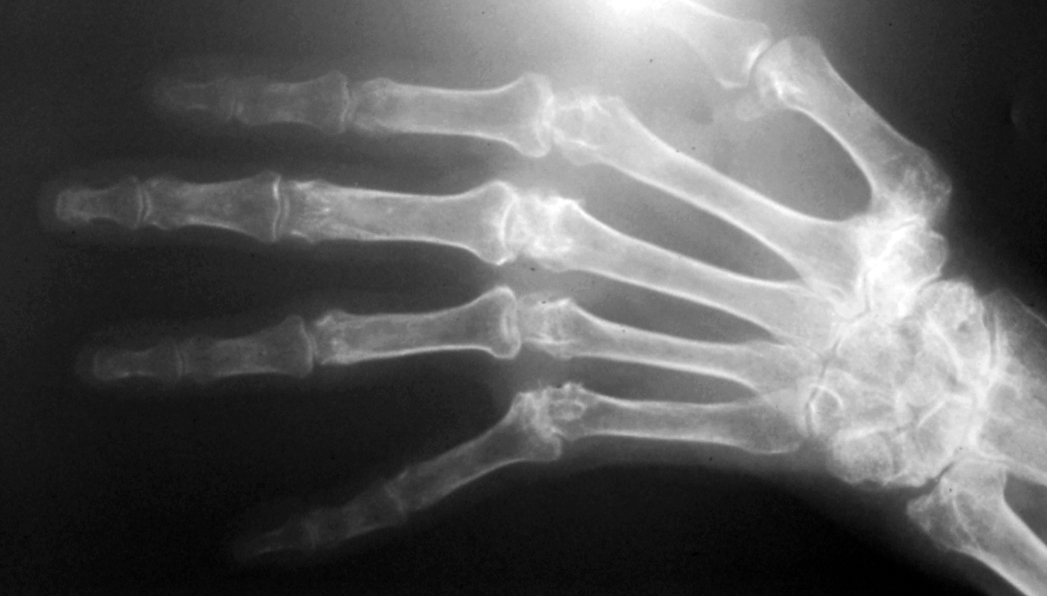Xray of rheumatoid hand - Noted destroyed wrist, finger MP joints and thumb CMC joint