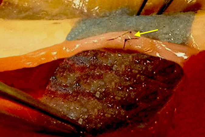 Radial dorsal sensory branch of the radial nerve undergoing a micro-surgical repair with an epieneural repair technique.