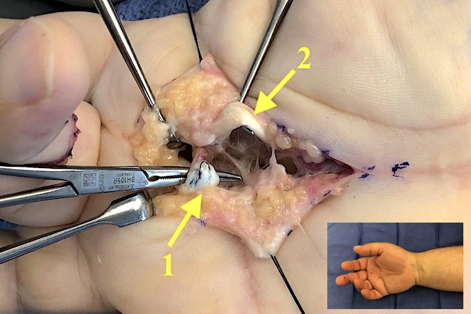 Carpenter ruptures 30 year old FDP repair. Distal end of FDP at #1.  Intact FDS repair at #2. Ruptured FDP repaired with primary PL tendon graft.