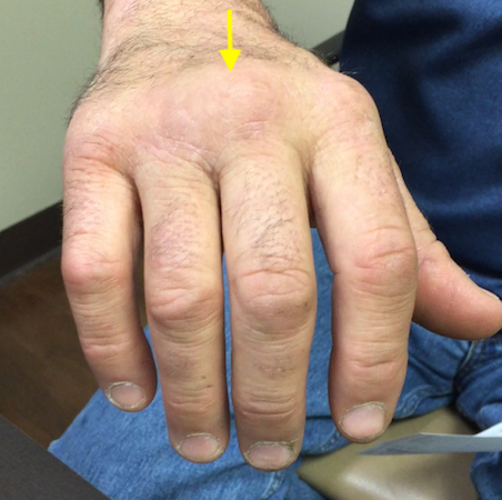 Sagittal band acute injury (arrow) with long finger MP joint swelling. "Boxer's Knuckle"