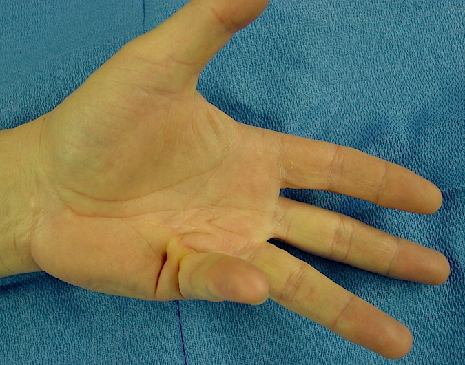 DUPUYTREN'S DISEASE | Hand Surgery Source
