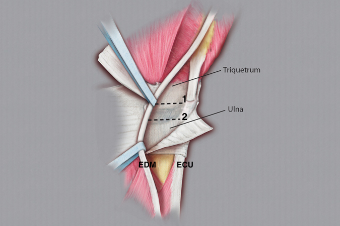 Capsular incisions for opening the RC joint (1) jus distal to the TFCC and (2) for opening the DRUJ and exposing the ulnar head just proximal to the TFCC.  Note tendon and bone labels.