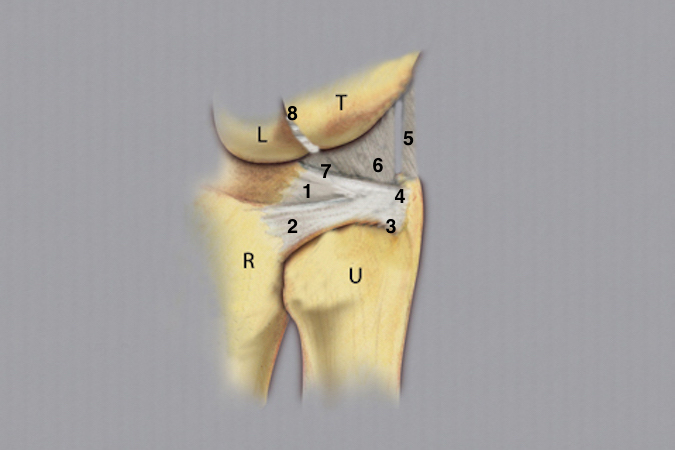 T - Triquetrum; L - Lunate; R - Radius; U - Ulnar head; 1- TFC articular disc; 2- Dorsal radioulnar ligament; 3- Deep radioulnar (foveal or ligament subcruentum) insertion; 4- Ulnar styloid TFCC insertion; 5- Ulnar collateral ligament (floor of the ECU tendon sheath; 6- Ulnotriquetral and ulnolunate ligaments; 7- Palmar (volar or anterior) radioulnar ligament; 8-  Lunotriquetral ligament.