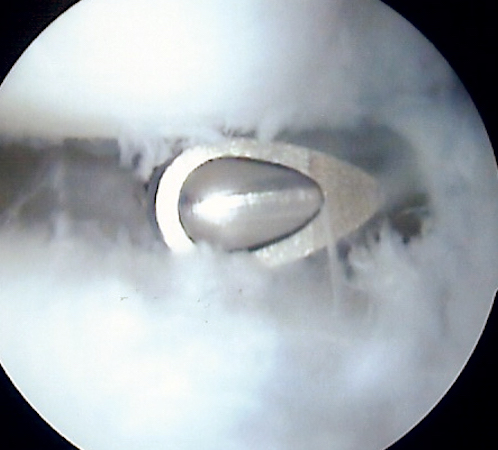 Arthroscopic image of the shaver deriding the central stable tear of the TFCC
