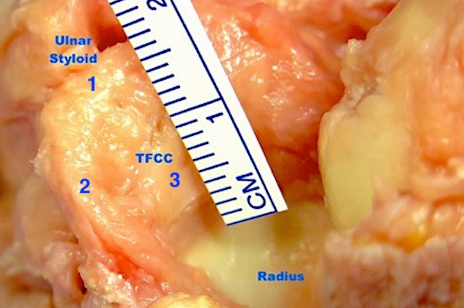 The RC joint has been open in this specimen . Note the ulnar styloid, TFCC and the lunate facet of the radius.  1. ulnar styloid insertion of the TFCC; 2. Palmar (volar or anterior) radioulnar ligament; 3. TFC articular central disc (fibrocartilage).