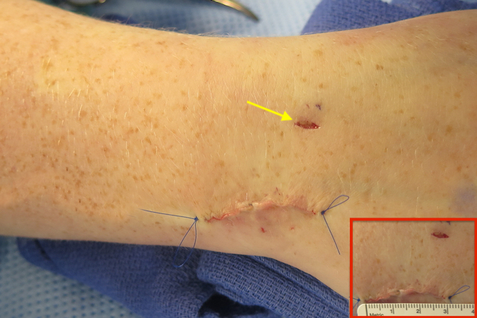 Closed 3cm incision.  The 3-4 portal incision (arrow) used for the wrist arthroscopy done before the TFCC repair will also be sutured.