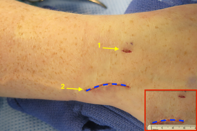  3cm incision (dashed blue line) for exposing the DRUJ and TFCC.