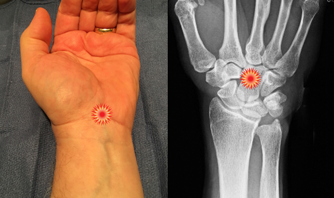 The red "tender" sign pin points the area of tenderness in relationship to the carpal bones  and the volar wrist surface anatomy of a patient with  Carpal Tunnel Syndrome.