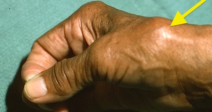 Arthritic thumb CMC joint with swelling and subluxation